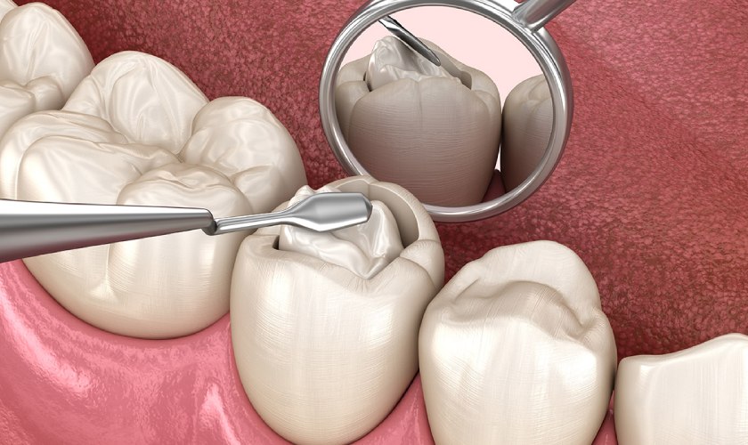 Kỹ thuật trám răng