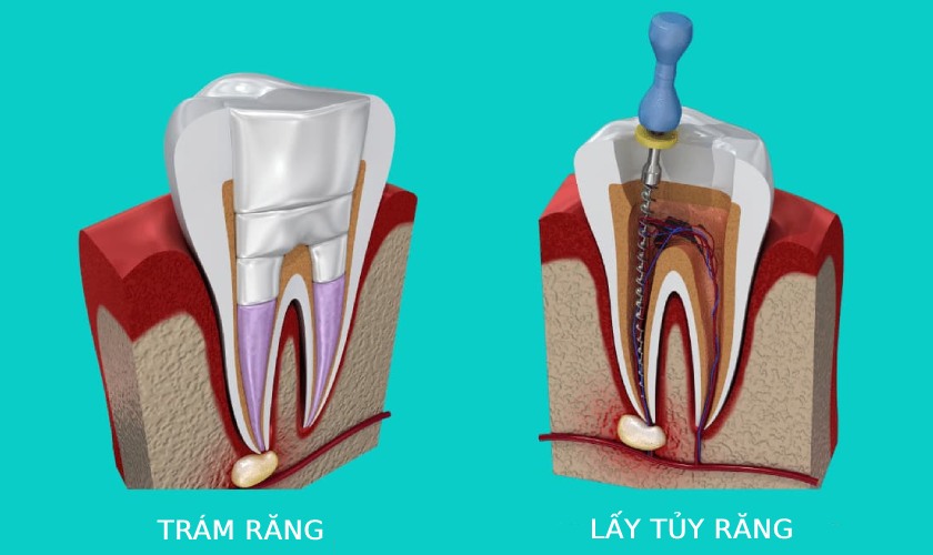 Trám răng và lấy tủy giá bao nhiêu còn tùy thuộc vào nhiều yếu tố