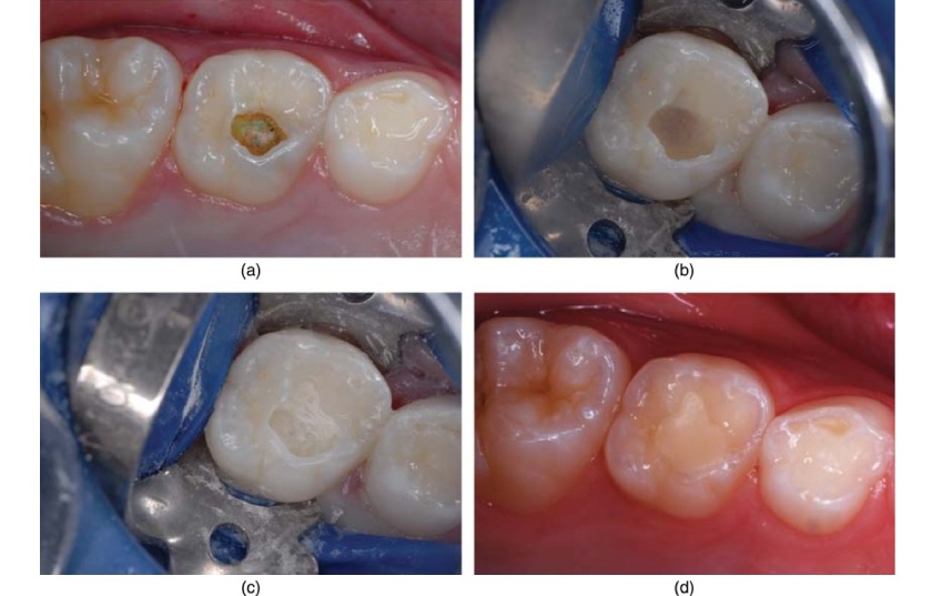 Răng sau khi trám răng và lấy tủy