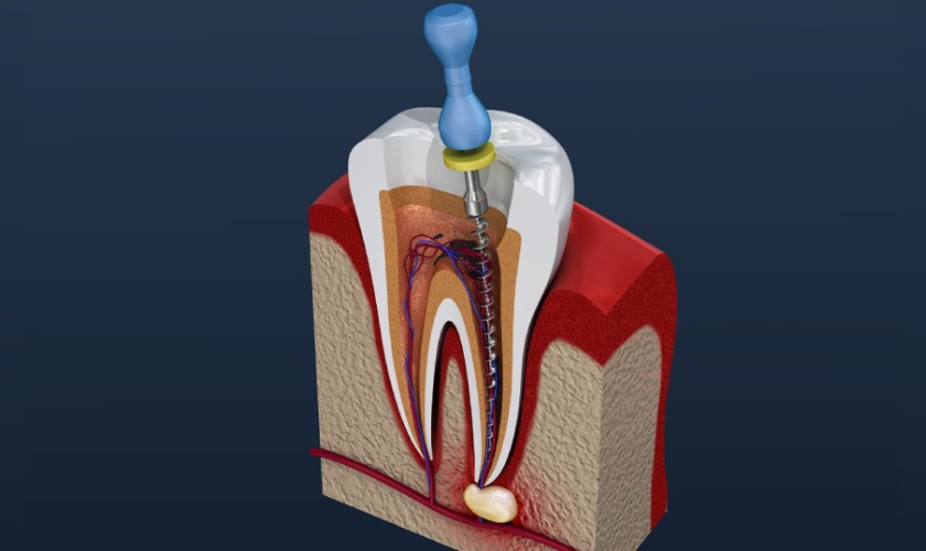 Những triệu chứng sau khi lấy tủy răng mà bạn nên biết