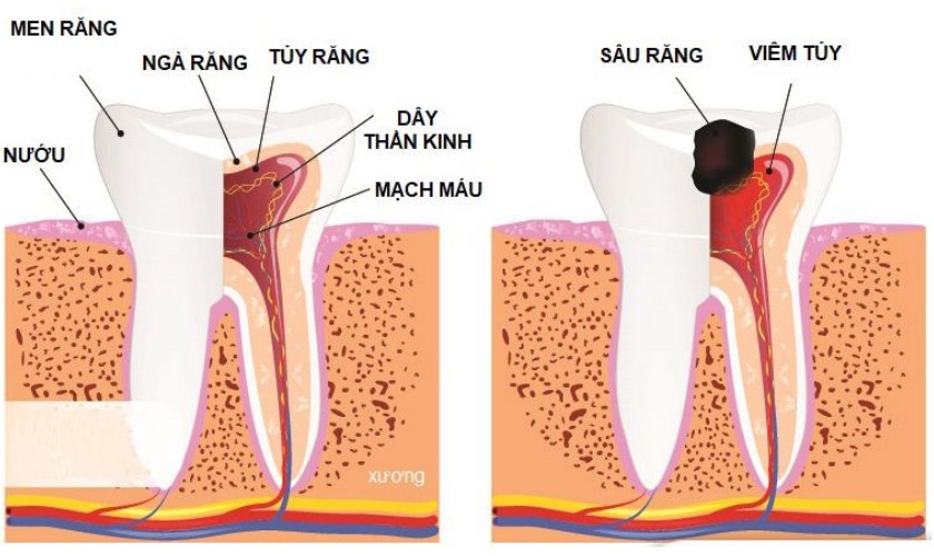 Tủy răng bị viêm nhiễm