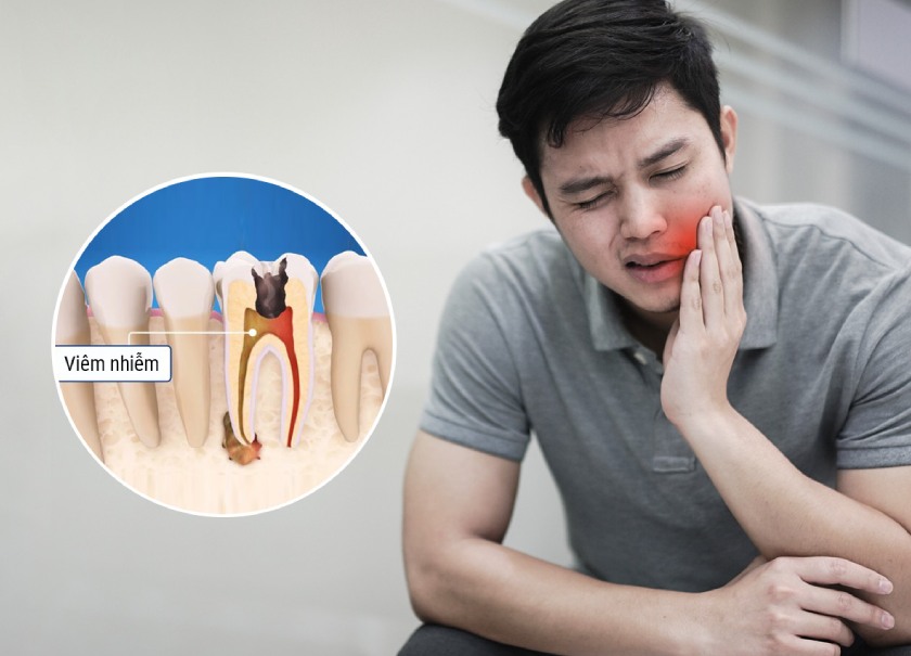 Đau nhức kéo dài sau khi lấy tủy răng