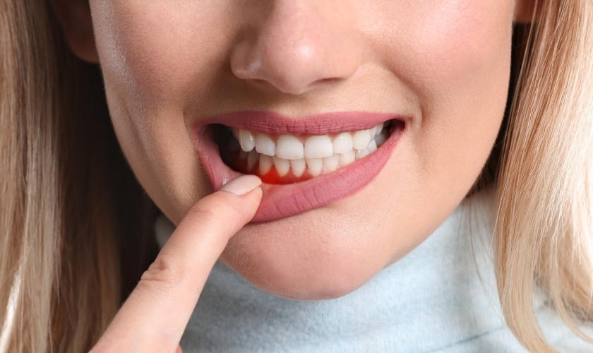 Nướu răng bị sưng sau khi lấy tủy