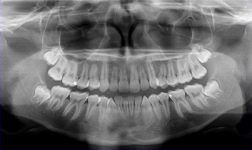Cần chụp CT răng trước khi nhổ răng khôn