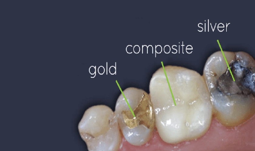 Kỹ thuật trám răng bằng Composite đảm bảo an toàn và độ tự nhiên