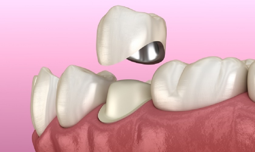 Mão răng sứ giúp bảo vệ răng thật bên trong khỏi các tác động xấu