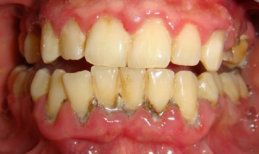 Cao răng tích tụ lâu ngày là nguyên nhân gây viêm lợi