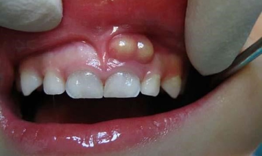 Có nên nặn mủ chân răng tại nhà không? Có nên nặn mủ chân răng tại nhà không?