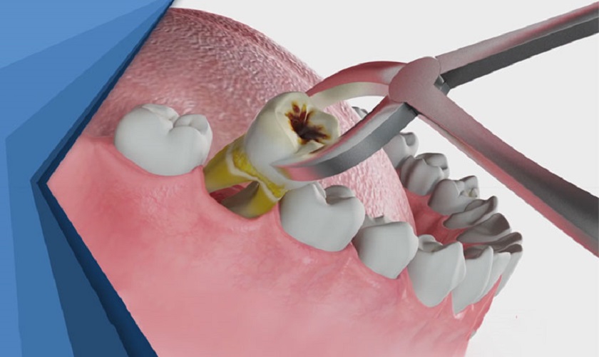 Nhổ răng là phương án điều trị cần thiết khi tình trạng viêm quá nặng Nhổ răng là phương án điều trị cần thiết khi tình trạng viêm quá nặng