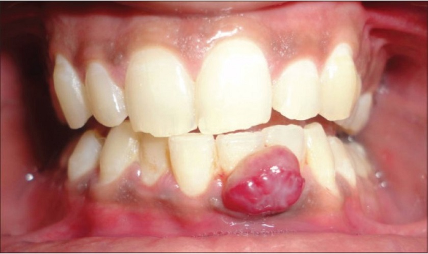 Các biến chứng có thể xảy ra nếu không điều trị viêm chân răng có mủ là gì?
