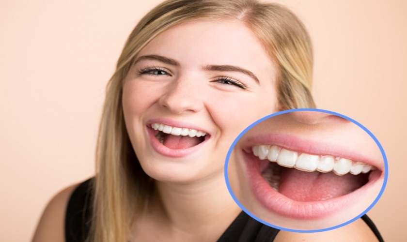 Niềng răng Invisalign giúp đảm bảo thẩm mỹ trong suốt quá trình điều trị