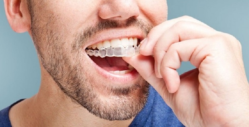 Niềng răng Invisalign có nhược điểm gì?