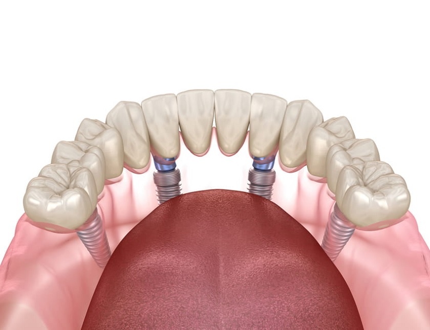 Răng implant có thể kéo dài hơn 25 năm nếu được chăm sóc đúng cách
