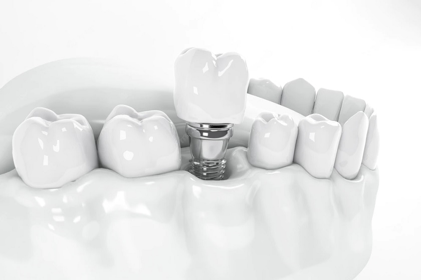 Phục hình răng sứ trên Implant