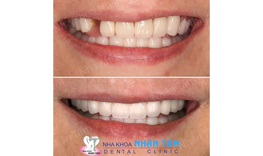 Khách hàng cấy ghép implant tại Nha khoa Nhân Tâm