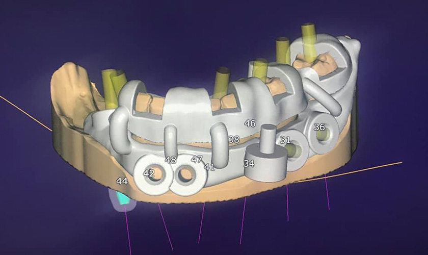 Công nghệ định vị mang đến nhiều lợi ích vượt trội so với máng hướng dẫn phẫu thuật