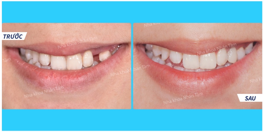 Công nghệ định vị cấy ghép Implant