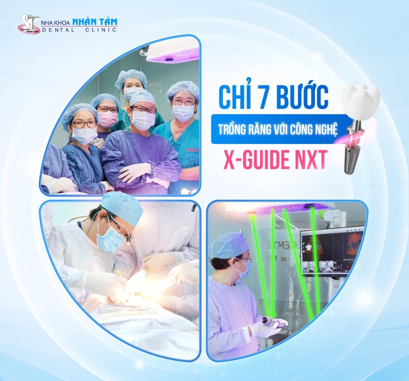 Quy trình trồng răng Implant bằng X-Guide NXT sẽ  diễn ra nhanh chóng nhưng vẫn đảm bảo hiệu quả và an toàn cho bệnh nhân