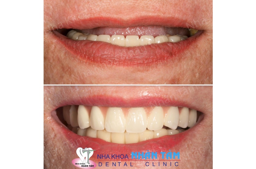 Kết quả khách hàng cấy ghép Implant bằng công nghệ định vị tại Nha khoa Nhân Tâm