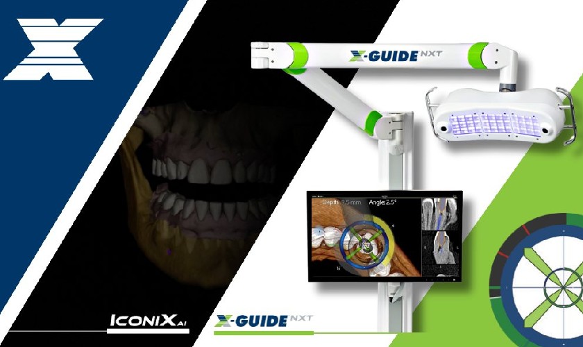 X-Guide NXT là công nghệ định vị thế hệ mới trong cấy ghép Implant