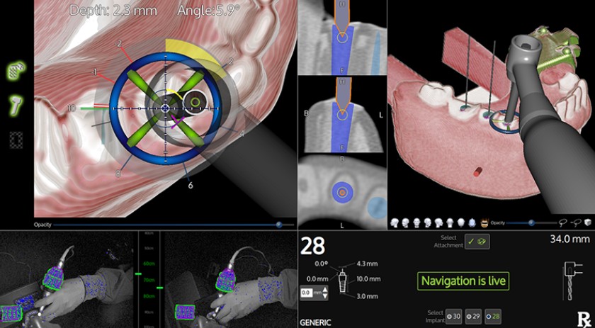 Với công nghệ X-Guide NXT, bác sĩ có thể nhìn thấy được hoạt động của mũi khoan trong xương hàm trực tiếp trên màn hình máy tính