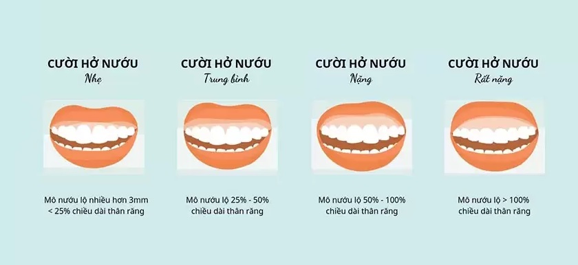 Các mức độ cười hở lợi