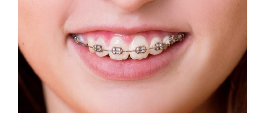 Niềng răng chữa cười hở lợi