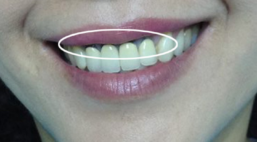 Hiện tượng đen viền nướu có thể xuất hiện sau một thời gian sử dụng răng sứ Titan