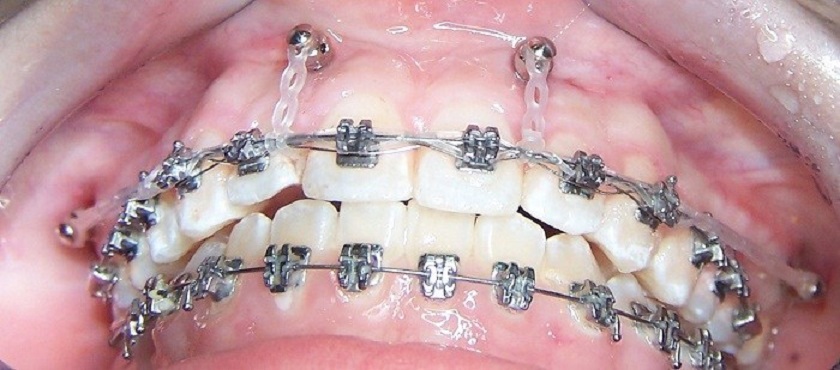 Biện pháp đánh lún răng trong nha khoa