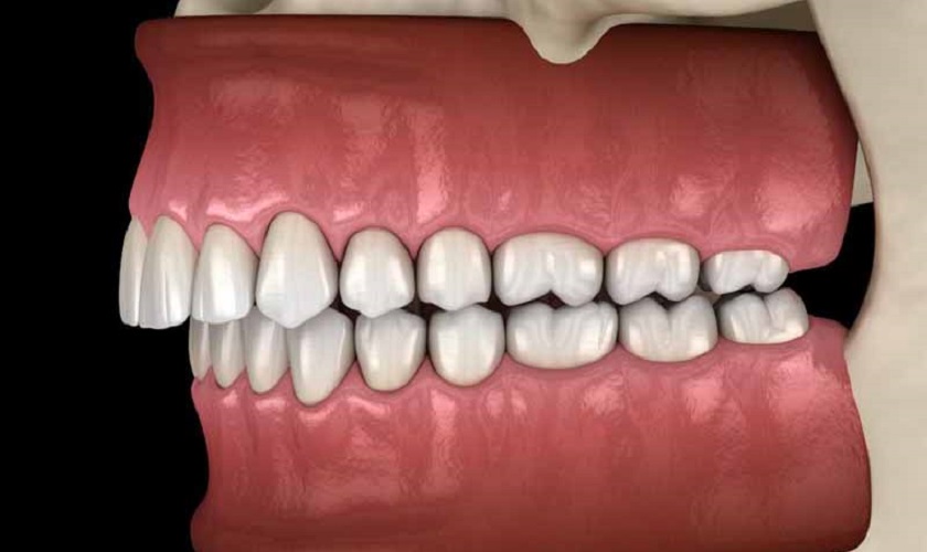 Đánh lún răng có thể được áp dụng để cải thiện tình trạng khớp cắn sâu