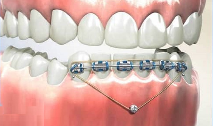 Cắm minivis để đánh lún răng