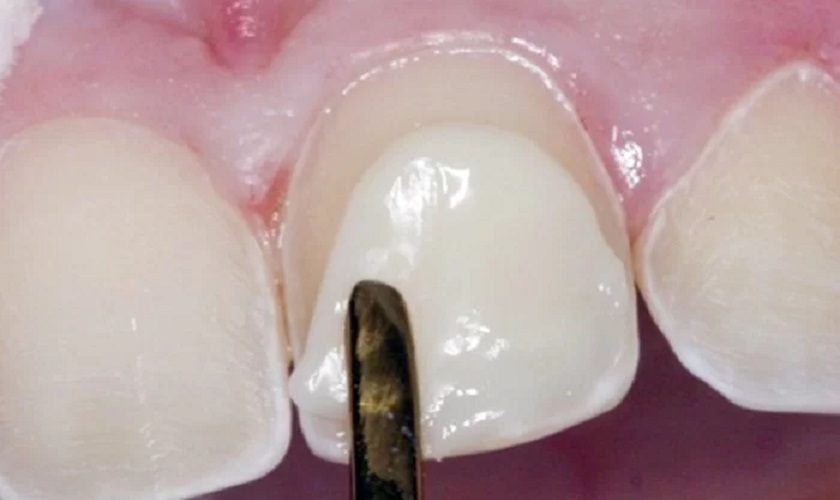 Phương pháp đắp răng khểnh bằng composite