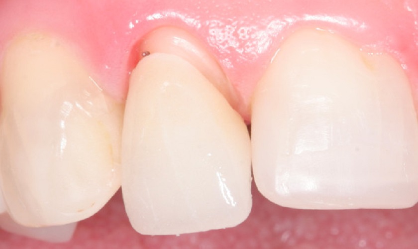 Dấu hiệu răng sứ bị hở