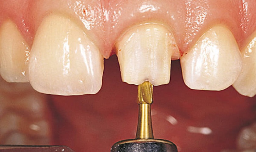 Mài răng sai kỹ thuật có thể khiến răng sứ kênh, hở