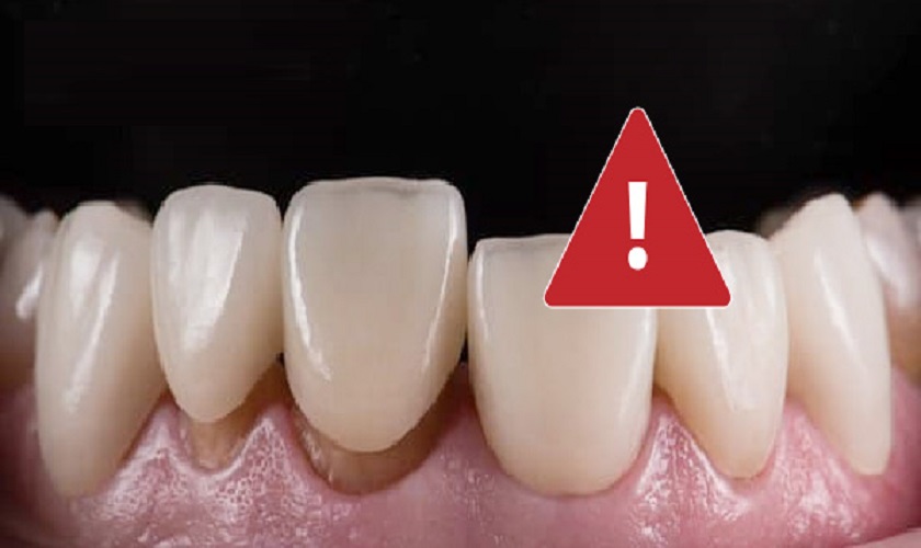 Dấu hiệu răng sứ bị hở chân răng là gì?
