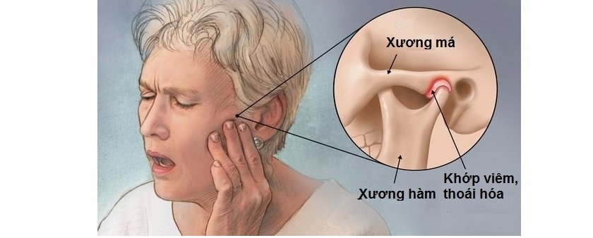 Tuổi tác cao là một trong những nguyên nhân gây viêm khớp thái dương hàm