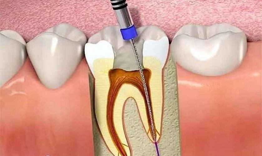 Cần điều trị tủy trong trường hợp sâu răng nặng gây viêm tủy để khắc phục tình trạng đau nhức
