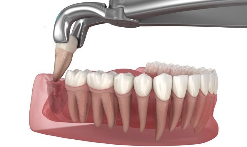 Nhổ răng khôn là phương án điều trị tối ưu khi chiếc răng này mọc bất thường gây đau nhức