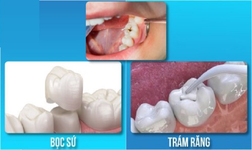 Phương pháp trám răng và bọc sứ răng sâu