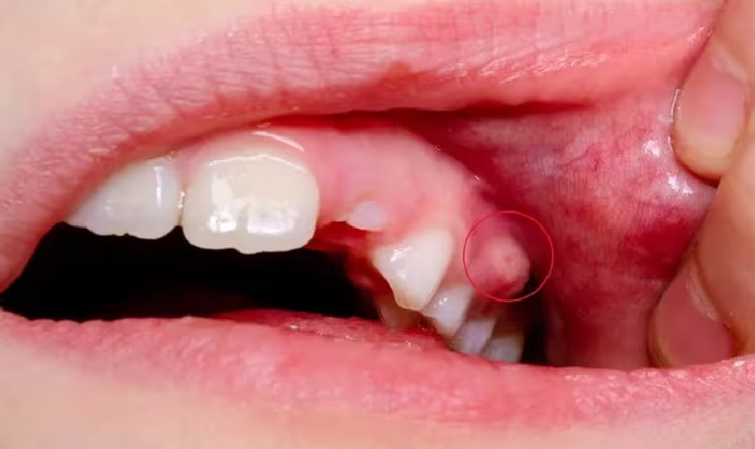 Áp xe răng là một bệnh lý nguy hiểm trong nha khoa