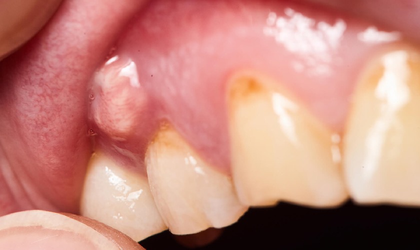 Áp xe răng có thể gặp ở bất kỳ ai