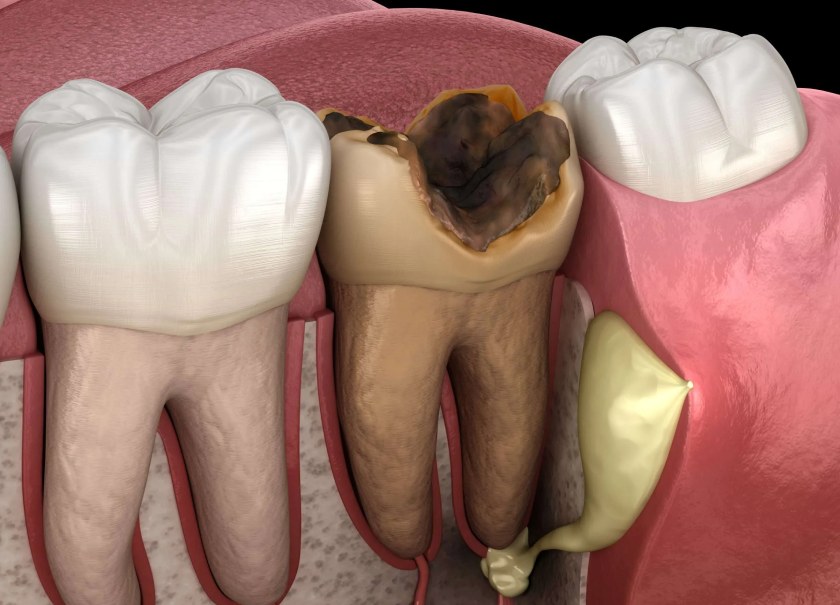 Sâu răng là nguyên nhân hàng đầu dẫn đến áp xe