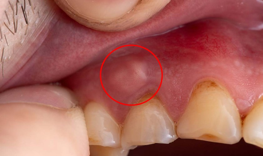 Hình thành túi mủ ở nướu răng