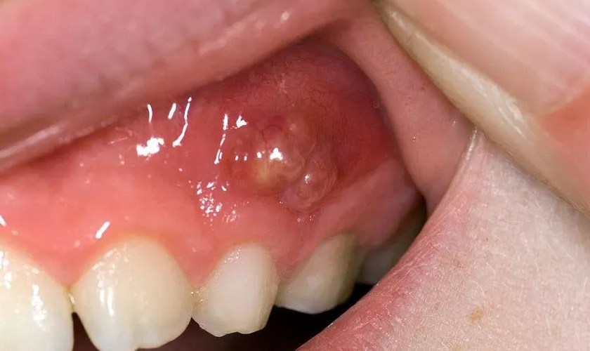 Áp xe răng nếu không được điều trị kịp thời sẽ gây nên nhiều biến chứng khôn lường