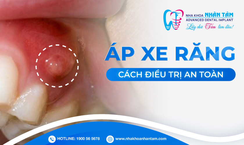 Áp xe răng là gì? Nguyên nhân, dấu hiệu và cách điều trị