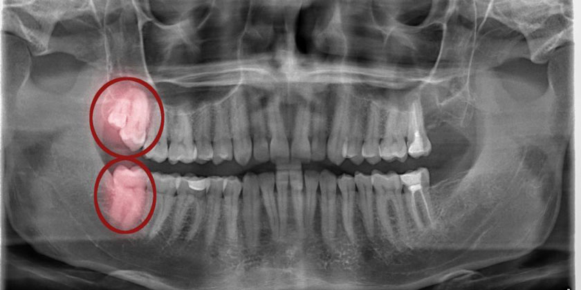 Mọc răng khôn thường gây đau nhức, viêm nhiễm