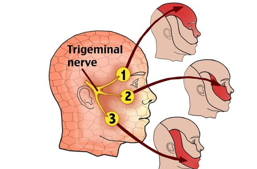 Đau nhức răng do đau dây thần kinh V