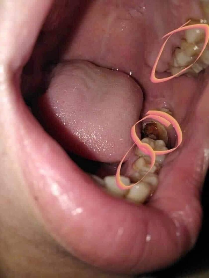 Răng sâu nặng chỉ còn chân răng thường được chỉ định nhổ bỏ