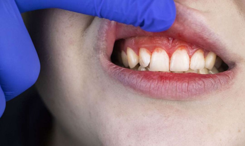 Viêm nướu là nguyên nhân hàng đầu khiến răng cửa bị đau nhức