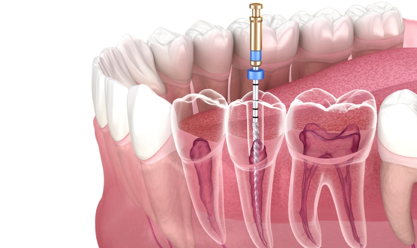 Phương pháp điều trị tủy